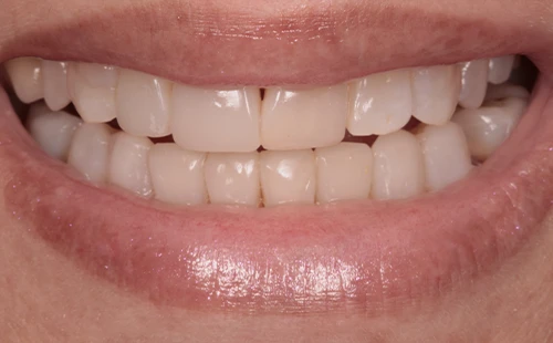 ClareamentoDental-IMG-01