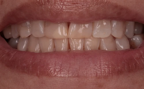 ClareamentoDental-IMG-02