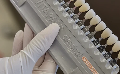 ClareamentoDental-IMG-03